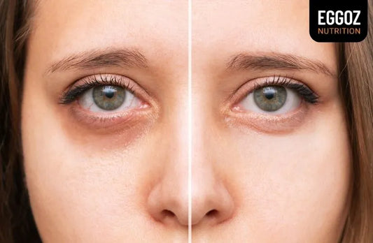 Believe me, These Remedies will Definitely Remove your under-eye Dark Circles!